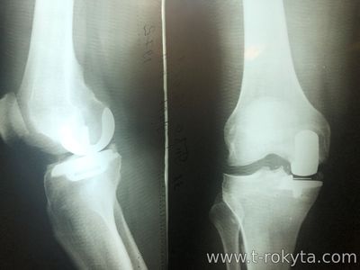 Одномищелкове ендопротезування колінного суглоба Одномищелкове ендопротезування колінного суглоба