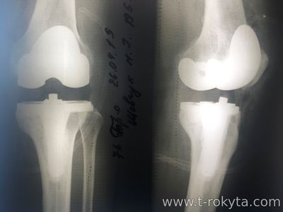 Ендопротезування колінного суглоба у нас Ендопротезування колінного суглоба у нас
