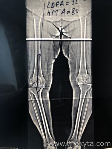 Тотальне ендопротезування колінного суглоба