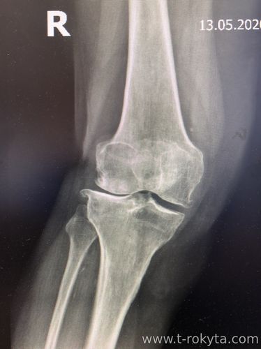Ендопротезування колінного суглоба