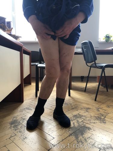 Ендопротезування коліна при значних деформаціях