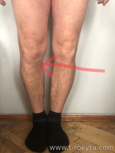 Одномищелкове ендопротезування колінного суглоба